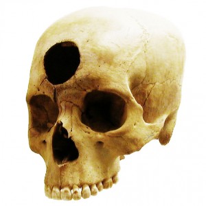 Trepanación frontal